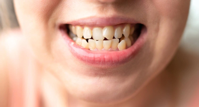 Before Invisalign Treatment