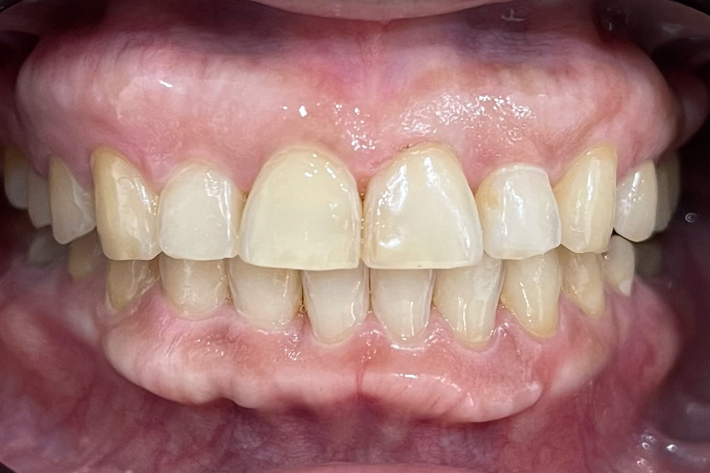 After Invisalign Treatment